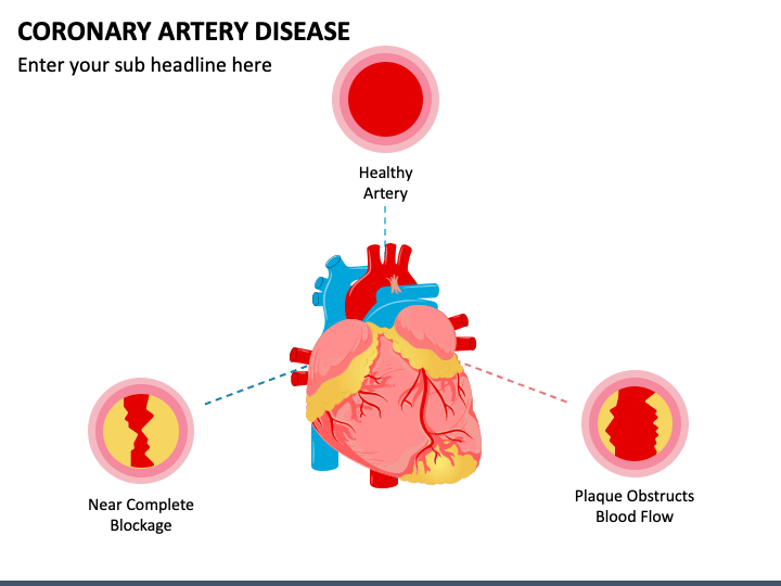 Coronary Artery Disease PPT Slide 1